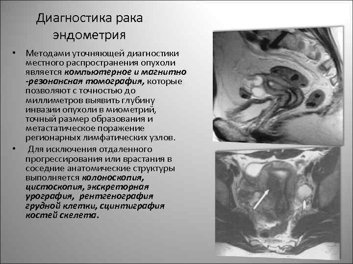 Диагностика рака эндометрия • Методами уточняющей диагностики местного распространения опухоли является компьютерное и магнитно