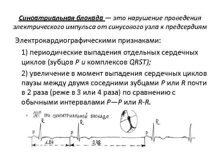 Синоатриальная блокада типы