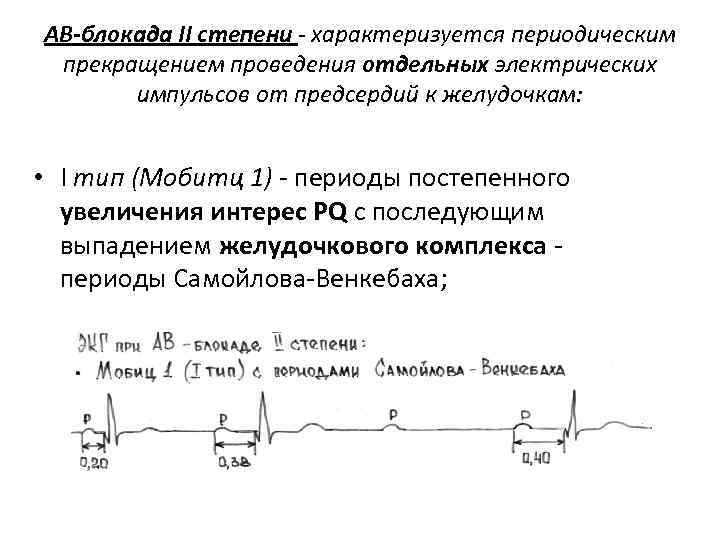 АВ-блокада II степени - характеризуется периодическим прекращением проведения отдельных электрических импульсов от предсердий к