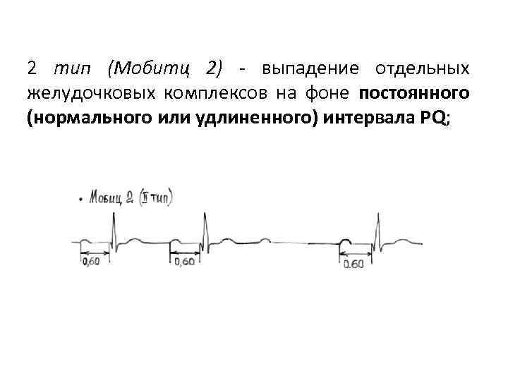 2 тип (Мобитц 2) - выпадение отдельных желудочковых комплексов на фоне постоянного (нормального или