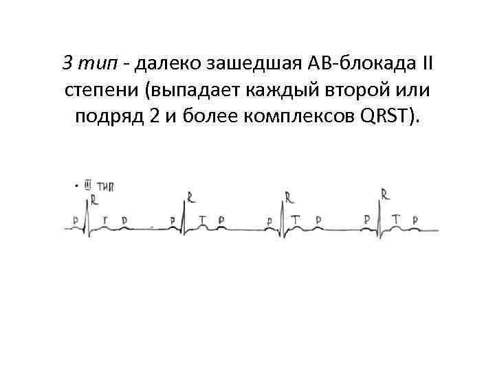 Типа дальше. Далеко зашедшая АВ блокада 2 степени. АВ блокада 2 степени далеко зашедшая на ЭКГ. Далекозашедшая АВ блокада 2. АВ блокада 2 степени далекозашедшая ЭКГ.