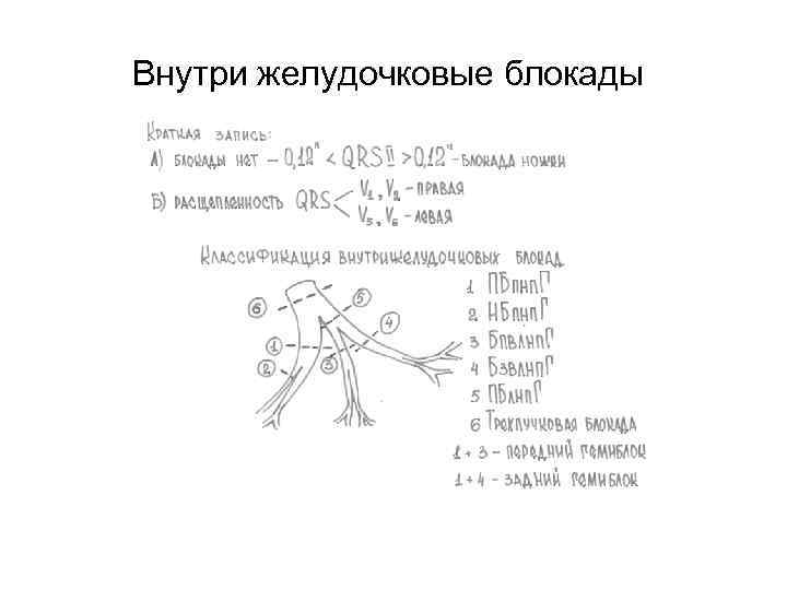 Внутри желудочковые блокады 