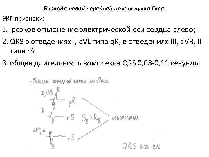 Блокада левой передней ножки пучка Гиса. ЭКГ признаки: 1. резкое отклонение электрической оси сердца