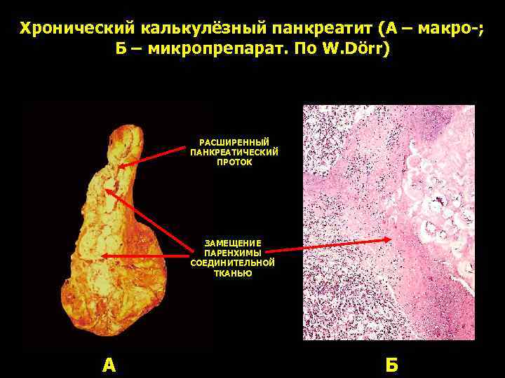 Хронический калькулёзный панкреатит (А – макро-; Б – микропрепарат. По W. Dörr) РАСШИРЕННЫЙ ПАНКРЕАТИЧЕСКИЙ