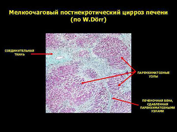 Мелкоочаговый постнекротический цирроз печени (по W. Dörr) СОЕДИНИТЕЛЬНАЯ ТКАНЬ ПАРЕНХИМАТОЗНЫЕ УЗЛЫ ПЕЧЕНОЧНАЯ ВЕНА, СДАВЛЕННАЯ