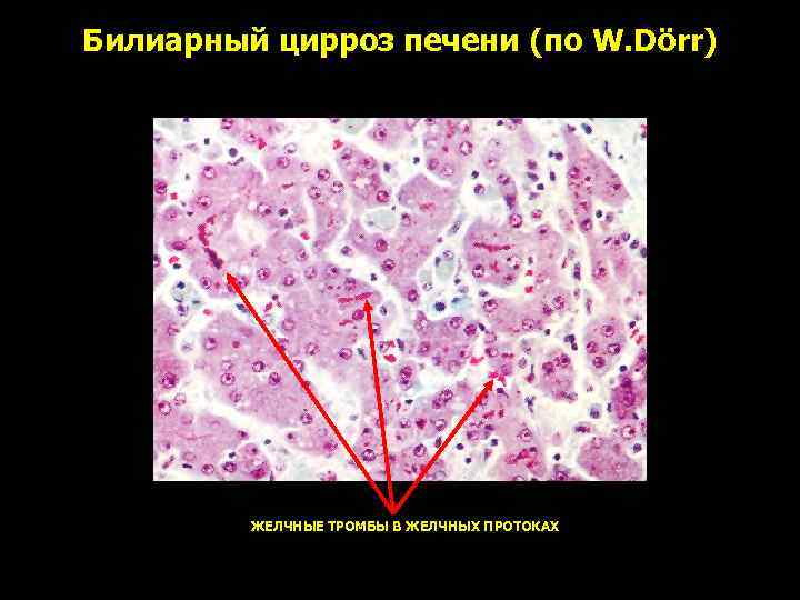 Билиарный цирроз печени (по W. Dörr) ЖЕЛЧНЫЕ ТРОМБЫ В ЖЕЛЧНЫХ ПРОТОКАХ 