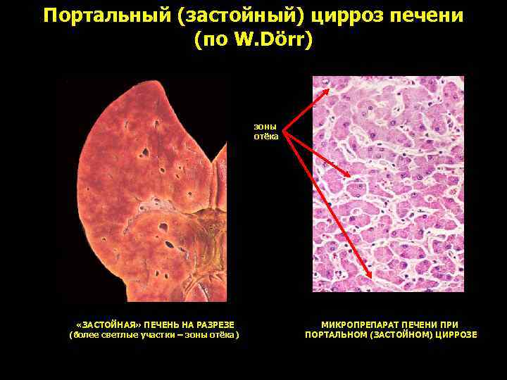 Цирроз печени амбулаторная карта