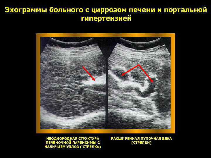 Эхограммы больного с циррозом печени и портальной гипертензией НЕОДНОРОДНАЯ СТРУКТУРА ПЕЧЁНОЧНОЙ ПАРЕНХИМЫ С НАЛИЧИЕМ