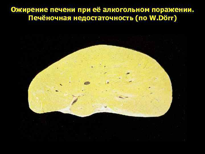Ожирение печени при её алкогольном поражении. Печёночная недостаточность (по W. Dörr) 