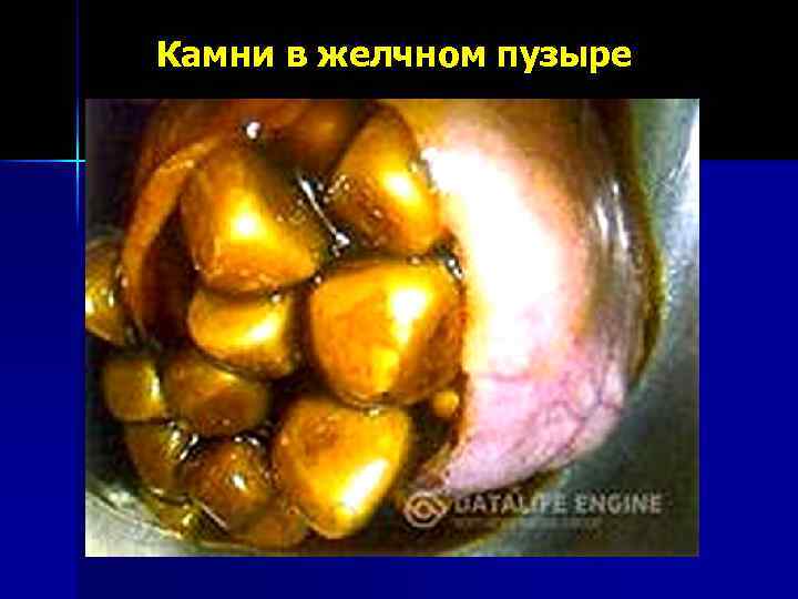 Камни в желчном пузыре 