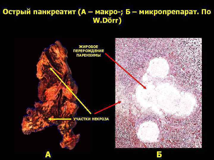 Острый панкреатит (А – макро-; Б – микропрепарат. По W. Dörr) ЖИРОВОЕ ПЕРЕРОЖДЕНИЕ ПАРЕНХИМЫ