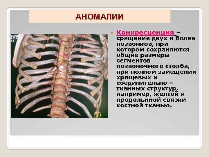 Сросшиеся позвонки. Аномалии развития ребер. Сращение ребер рентген. Аномалия развития первых ребер.