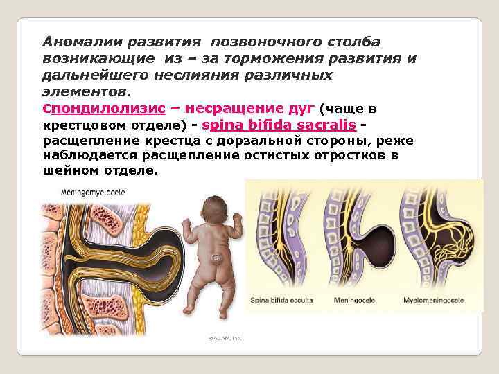 Аномалии развития позвоночного столба возникающие из – за торможения развития и дальнейшего неслияния различных