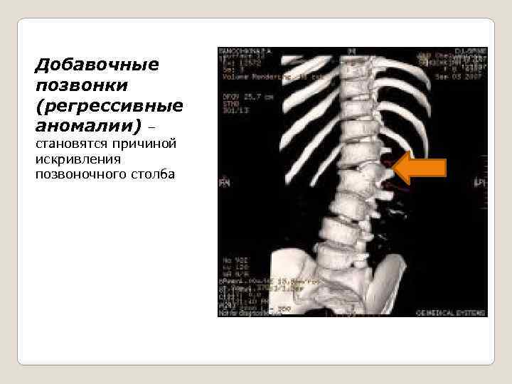 Добавочные позвонки (регрессивные аномалии) – становятся причиной искривления позвоночного столба 