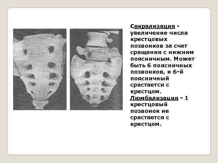 Сакрализация - увеличение числа крестцовых позвонков за счет сращения с нижним поясничным. Может быть