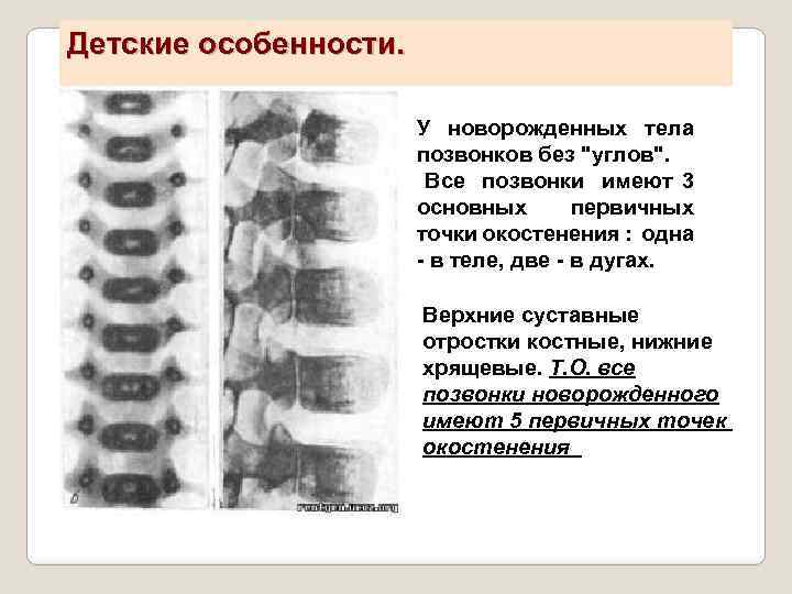 Детские особенности. У новорожденных тела позвонков без 