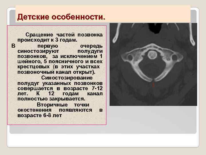 Детские особенности. Сращение частей позвонка происходит к 3 годам. В первую очередь синостозируют полудуги