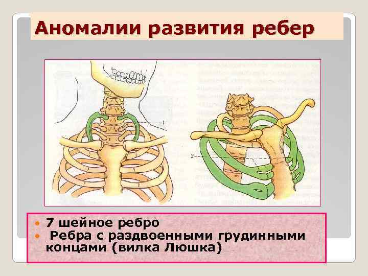 Аномалии развития ребер 7 шейное ребро Ребра с раздвоенными грудинными концами (вилка Люшка) 