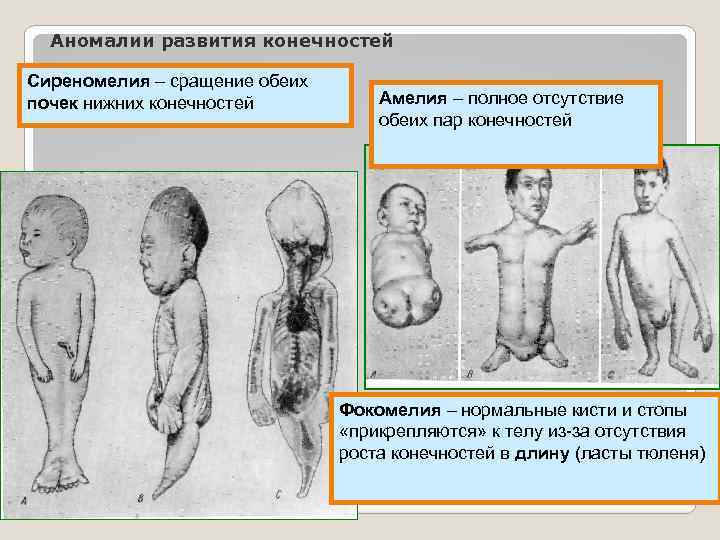 Аномалии развития конечностей Сиреномелия – сращение обеих почек нижних конечностей Амелия – полное отсутствие