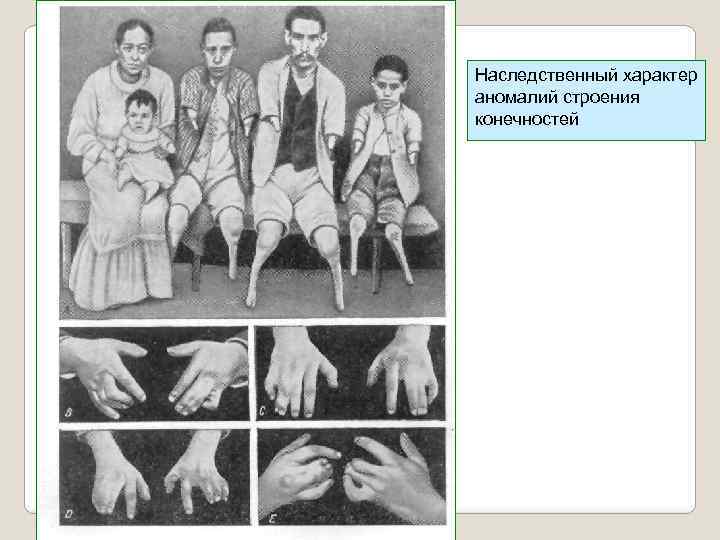 Наследственный характер аномалий строения конечностей 