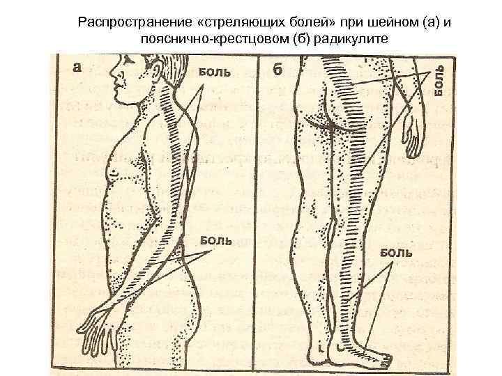 Распространение «стреляющих болей» при шейном (а) и пояснично-крестцовом (б) радикулите 