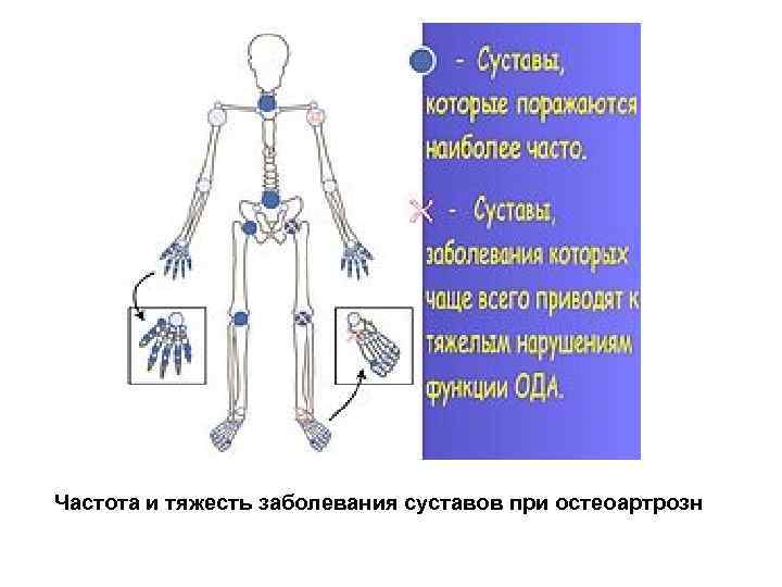 Частота и тяжесть заболевания суставов при остеоартрозн 