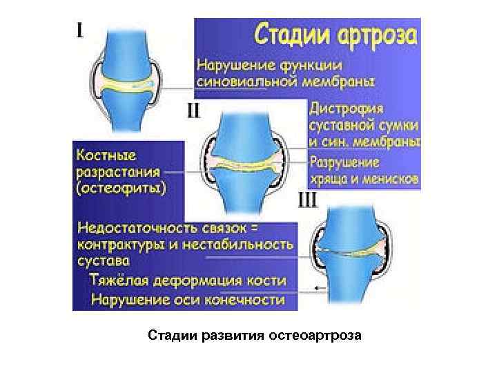 Стадии развития остеоартроза 