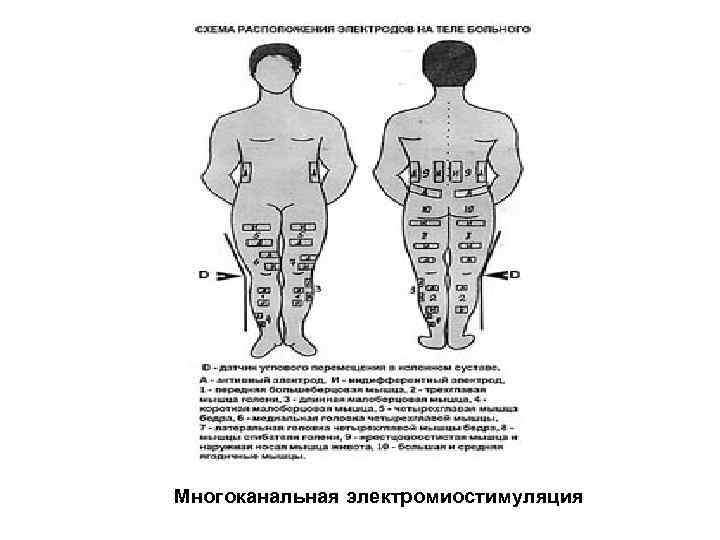 Многоканальная электромиостимуляция 