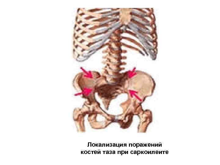 Локализация поражений костей таза при саркоилеите 