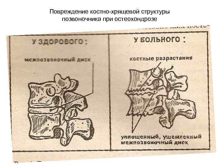 Повреждение костно-хрящевой структуры позвоночника при остеохондрозе 