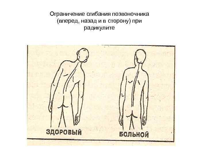 Ограничение сгибания позвоночника (вперед, назад и в сторону) при радикулите 