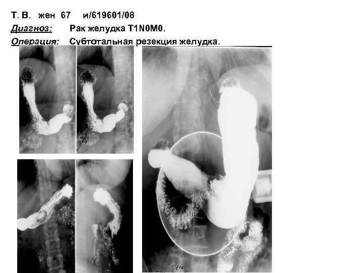 Т. В. жен 67 и/619601/08 Диагноз: Рак желудка Т 1 N 0 M 0.