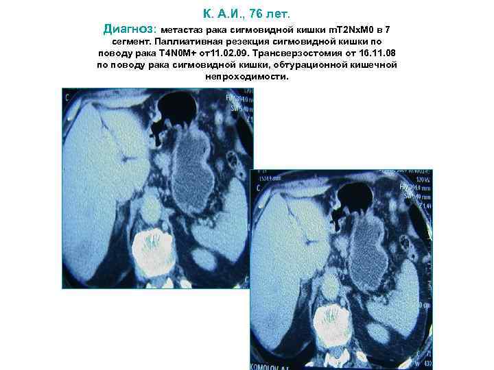 Рак кишечника метастазы прогноз. Опухоль сигмовидной кишки на кт. Кт при метастазах опухоли кишечника.