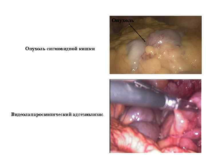 Опухоль сигмовидной кишки Видеолапароскопический адгезиолизис 