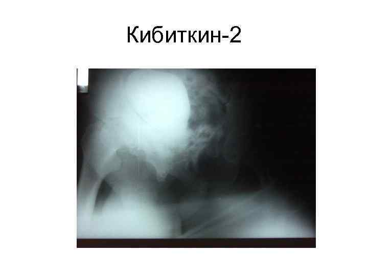 Кибиткин-2 