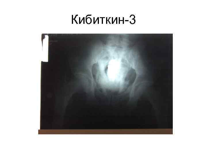 Кибиткин-3 