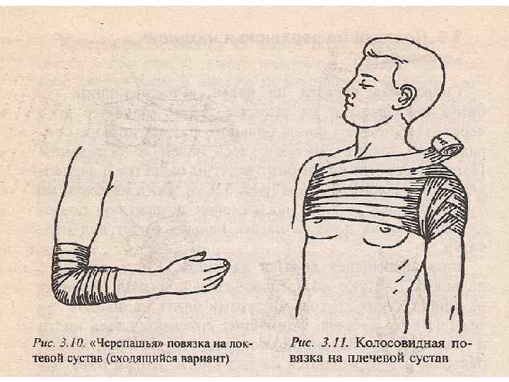 Колосовидная повязка на плечевой сустав. ПМП при ранении мягких тканей. ПМП разрыв мягких тканей. Первая врачебная помощь при ранении мягких тканей. Первая помощь при открытых повреждениях мягких тканей..