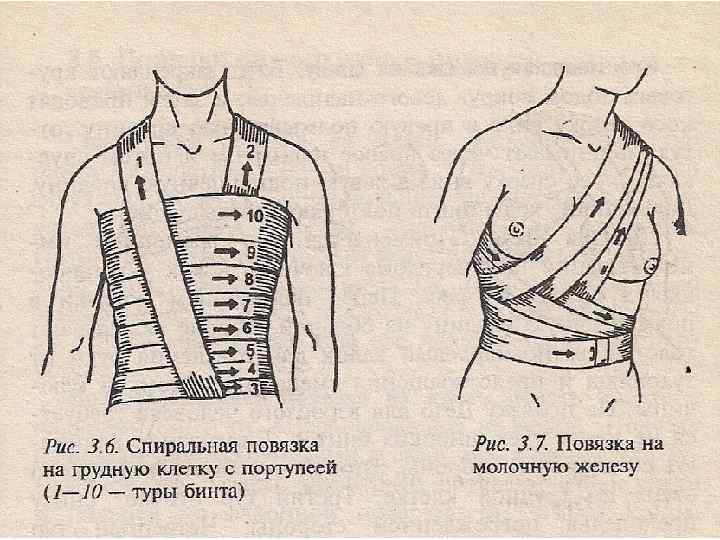 Повязка на молочную железу. Повязка портупея на грудную клетку. Повязка портупея по Сальникову гипсовая. Спиральная повязка на молочную железу.