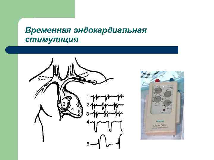 Временная эндокардиальная стимуляция 