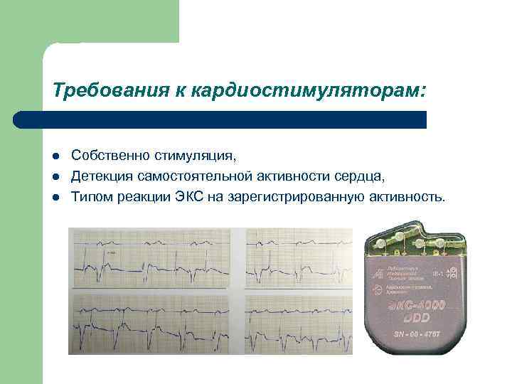 Экс это. Детекция при экс это. Типы кардиостимуляторов сердца. Детекция импульсов кардиостимулятора.