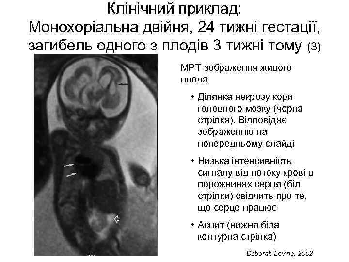 Клінічний приклад: Монохоріальна двійня, 24 тижні гестації, загибель одного з плодів 3 тижні тому