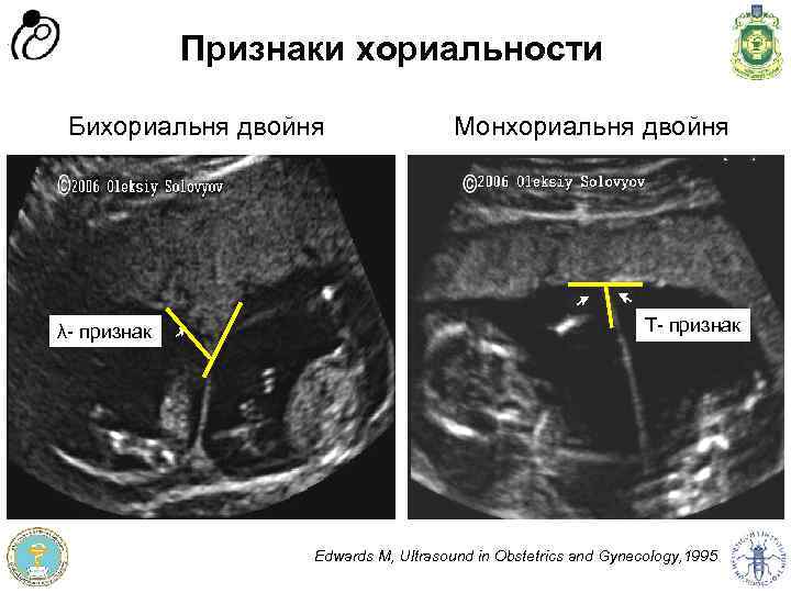 Признаки хориальности λ- признак Монхориальня двойня Т- признак Edwards M, Ultrasound in Obstetrics and