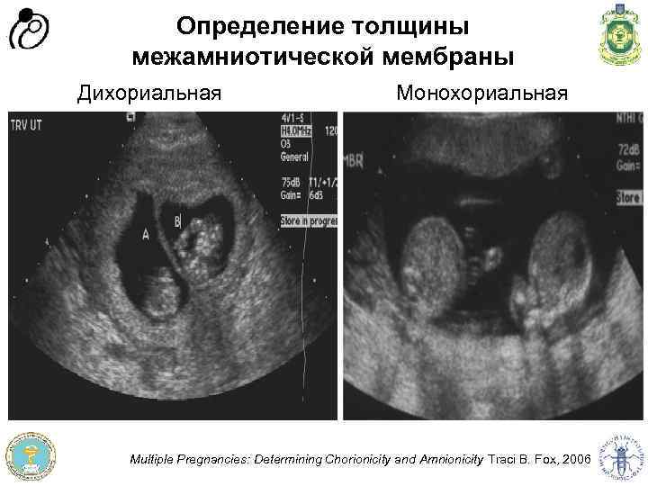 Определение толщины межамниотической мембраны Монохориальная Програма доров'я матері та дитини” Швейцарія - Україна Програма