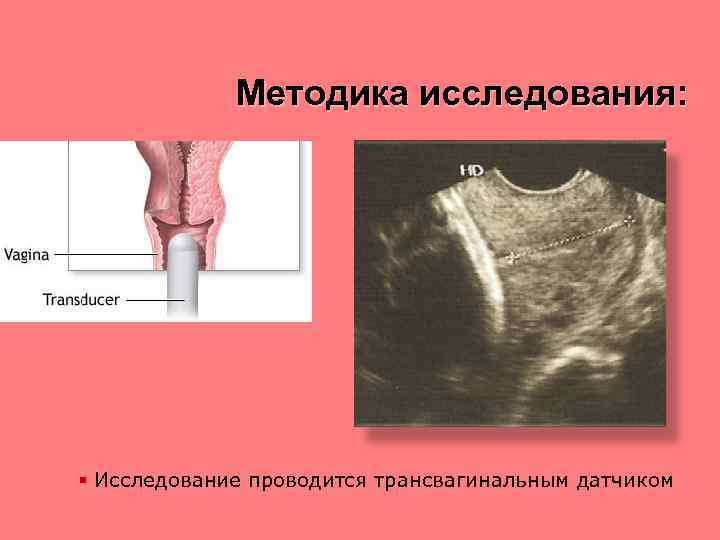 Методика исследования: § Исследование проводится трансвагинальным датчиком 