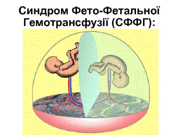 Синдром Фето-Фетальної Гемотрансфузії (СФФГ): 