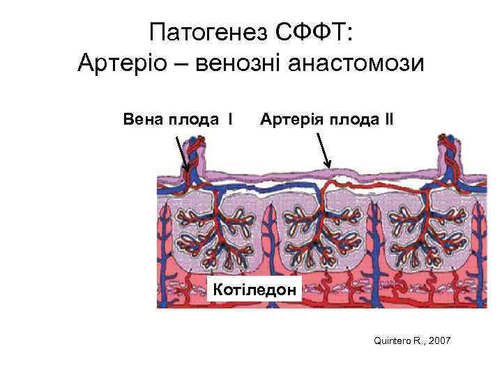 Патогенез СФФТ: Артеріо – венозні анастомози Вена плода I Артерія плода II Котіледон Quintero
