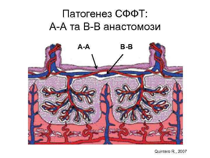 Патогенез СФФТ: А-А та В-В анастомози А-А В-В Quintero R. , 2007 