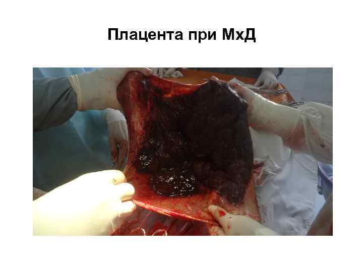 Плацента при Мх. Д 