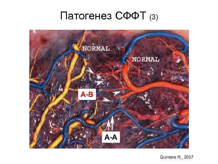 Патогенез СФФТ (3) А-В А-А Quintero R. , 2007 