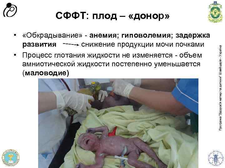  • «Обкрадывание» - анемия; гиповолемия; задержка развития снижение продукции мочи почками • Процесс